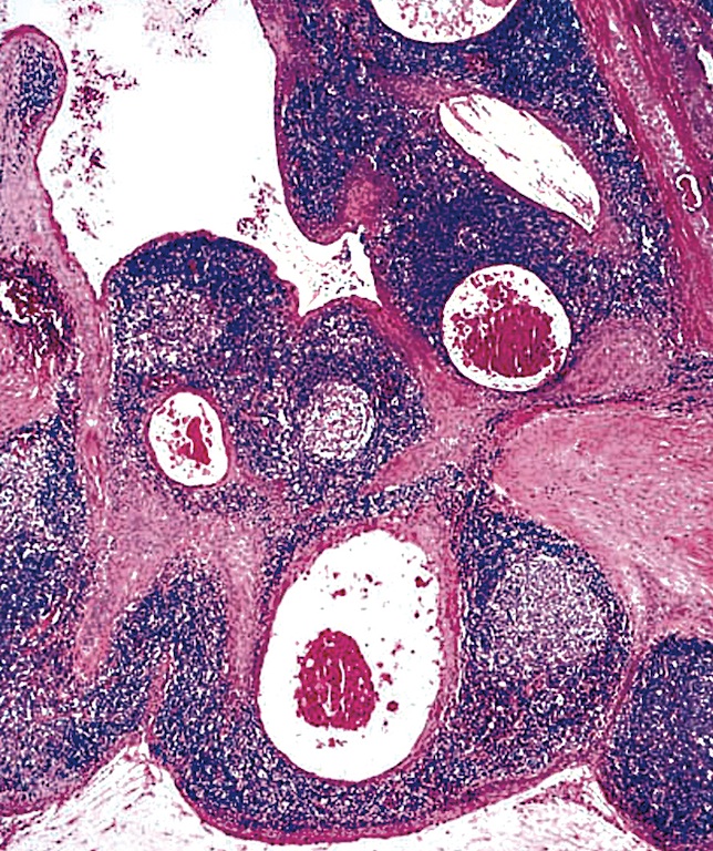 Thyroiditis Thyroiditis Pathology Outlines 2390